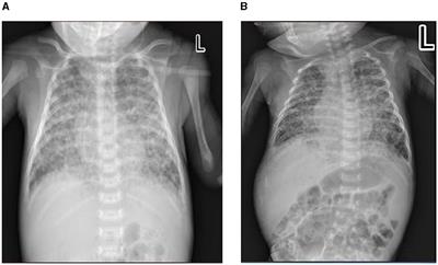 Case report: Congenital multidrug-resistant tuberculosis